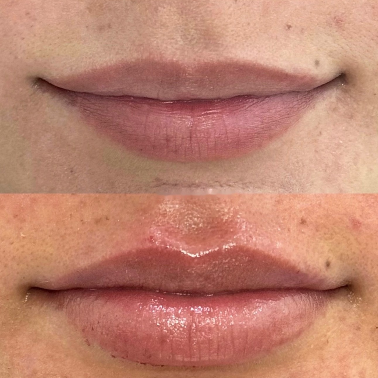 Resultado de harmonização labial no Instituto Paulo Sérgio Gomes