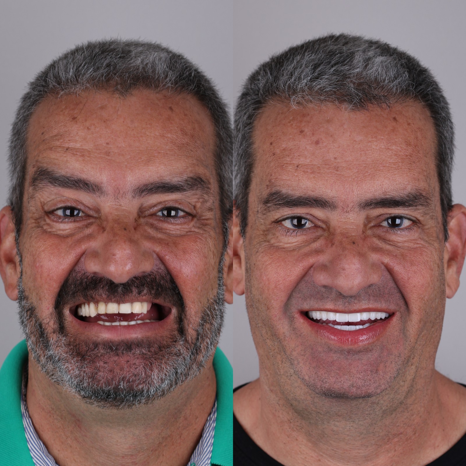 Resultado real de paciente do Instituto Paulo Sérgio Gomes